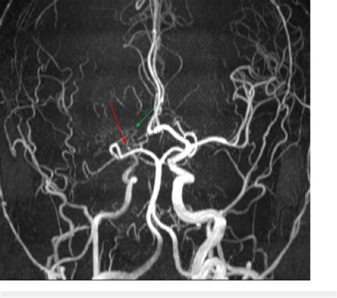 Three Dimension 3D Time Of Flight Magnetic Resonance MR Angiogram