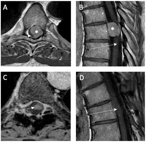 Medicina Free Full Text Spinal Meningioma Surgery Through The Ages