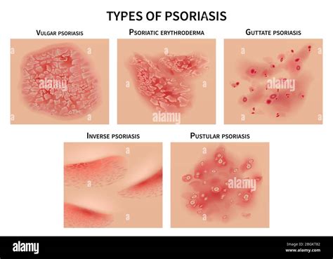 Tipos De Psoriasis Urticaria De La Piel Enfermedades De La Dermia Ilustración De Vector