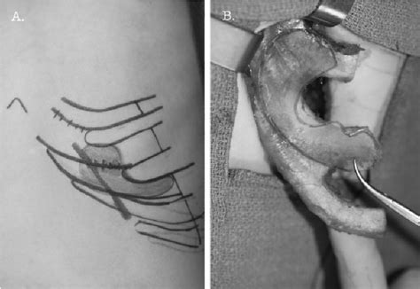 Harvesting The Costal Cartilage A The Oblique Incision Provides