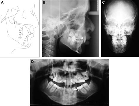 Interdisciplinary Management Of A Patient With A Bilateral Cleft Lip And Palate And 12