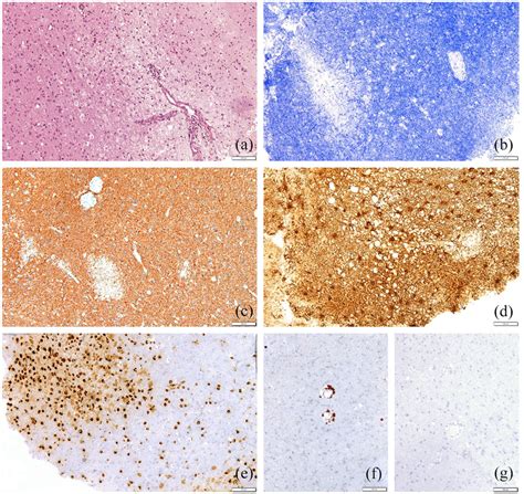 (a) H&E showed fragments of brain parenchyma with patchy infiltrates of... | Download Scientific ...