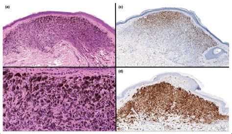 A Melanophages Occupying The Superficial And Mid Dermis With No