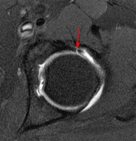 Postoperative Hip MRI in Patients Treated for FAI | Radsource