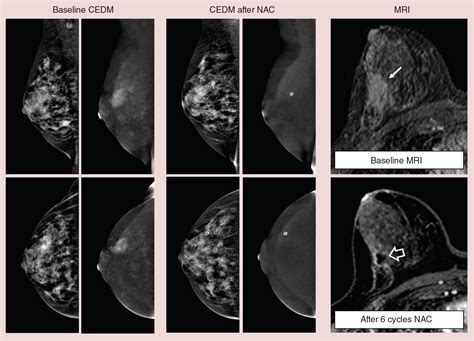 Contrast Enhanced Dual Energy Mammography A Promising New Imaging Tool