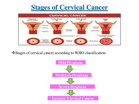 Doc seminar cervical cancer