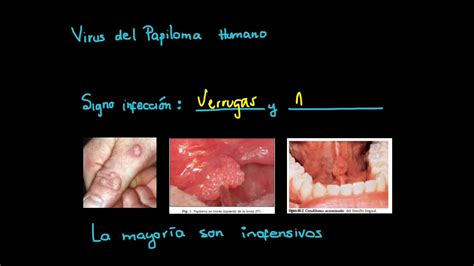 Virus Y Cavidad Oral Virus Del Papiloma Humano Youtube