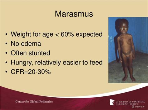 PPT - Protein Energy Malnutrition PowerPoint Presentation, free ...