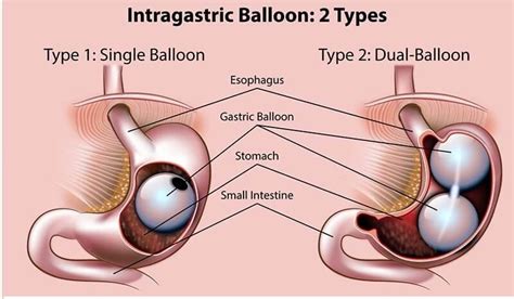 Inserting A Gastric Balloon Treatment For Abroad Patient