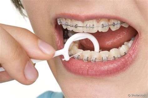 5 dicas para cuidar do seu aparelho dentário Implantes dentários e