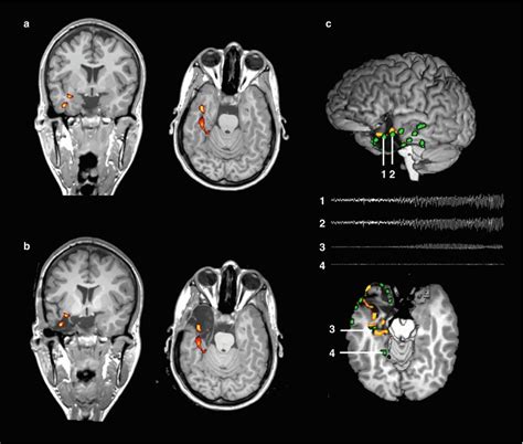 Eeg Fmri In Epilepsy Radiology Key