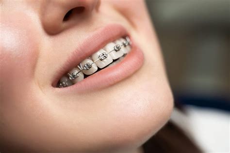 Invisalign Vs Ceramic Braces