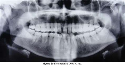 Figure 2 From Mini Retromandibular Approach For Open Reduction And