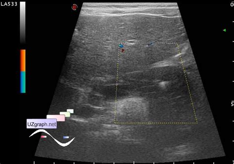 Abdomen Sonography Lesion In The Pancreas Clinical Report Video