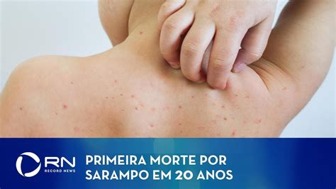 Bebê é a primeira vítima de sarampo no Rio de Janeiro após anos a