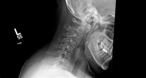 Atlantoaxial Subluxation Radiology Case King Faisal