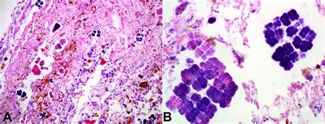 Photomicrograph Of The Stomach A Sarcina Ventriculi Identification In