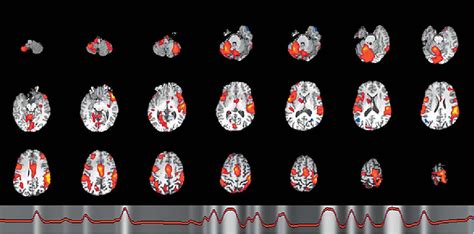 Figure 1 From Treatment Of Alice In Wonderland Syndrome And Verbal Auditory Hallucinations Using