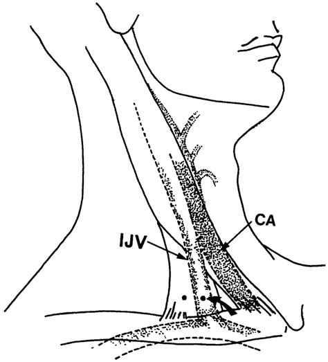 Relation Of The Internal Jugular Vein IJV To The Clavicular Head Of