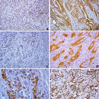 Overview Of Clinicopathological Data And Immunohistochemical Staining