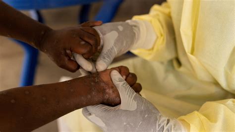 Who Declares Mpox Outbreaks In Africa A Global Health Emergency As A