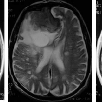 Preoperative T1 Weighted A T2 Weighted B And Contrast Enhanced