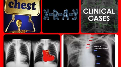 Chest X Ray Made Easy 👌 ️ Clinical Xray Chest Cxr Radiology Pulmonology Clinical