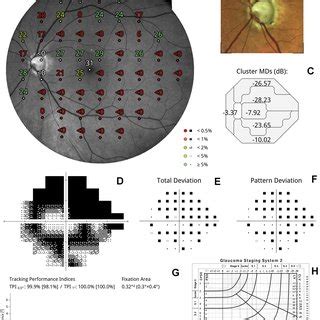 Compass Fundus Automated Perimetry FAP Output A Fundus Related