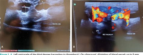 Figure 1 From Spermatic Vein Thrombosis As A Rare Cause Of Testicular