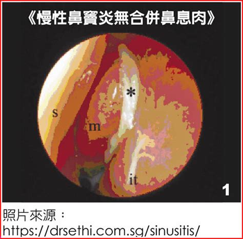 治療慢性鼻竇炎 提升生活品質 生活新聞 中國時報