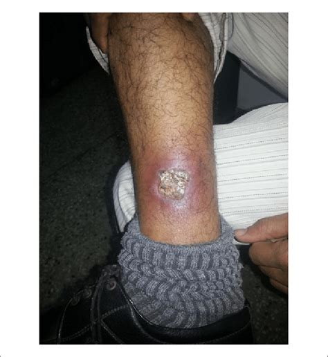 A Neglected Case Of Third Degree Muffler Induced Burn With Exposed Bone