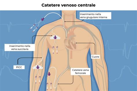 Catetere Venoso Centrale Cvc In Cosa Consiste E Quando Serve