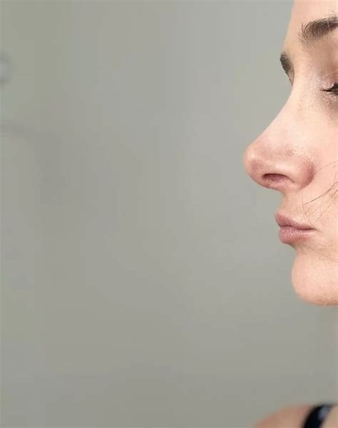 Rhinoplastie en anesthésie locale Rhinoplastie chirurgie du nez