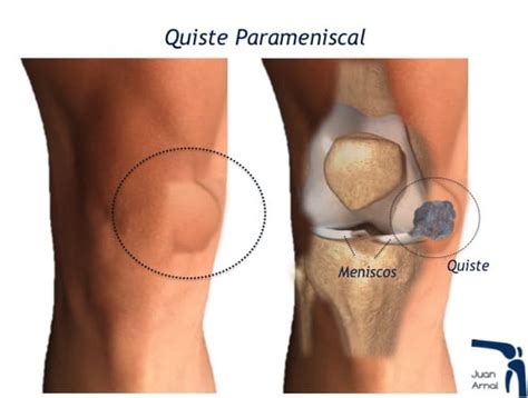 Bulto En La Rodilla Que Se Mueve Normalweb Es