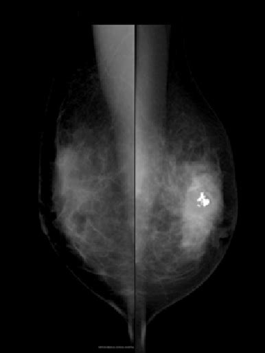 Figure 1 From Mucinous Carcinoma Of The Breast Accompanied By Coarse