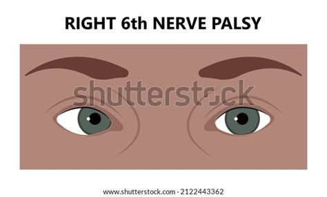 Diplopia Double Vision Test Exam Brain Stock Vector Royalty Free