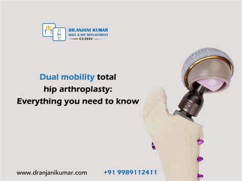 Dual Mobility Total Hip Arthroplasty Everything You Need To Know Dranjani Kumar Orthopaedic