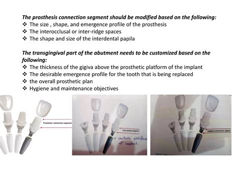 Different Implant Abutment Connections Ppt