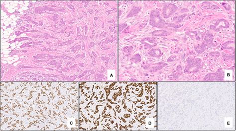 Nottingham Grade 2 Invasive Ductal Carcinoma No Special Type Of The