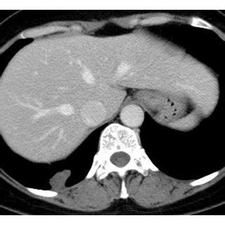 CT scan at lung window setting shows subpleural nodule with pleural ...