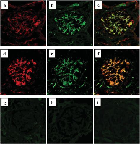 Immunofluorescence Staining For Complement Components In MPO AAGN A C