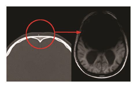 Interactions Of An Mri Scanner And A Small Metal Foreign Body The Size Download Scientific