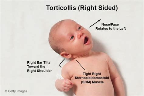 What You Need To Know About Torticollis Performance Optimal Health