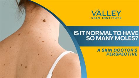 Understanding Moles: Dermatologist's Guide to Skin Health 