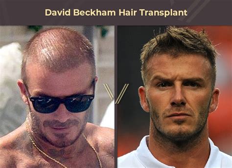 12 Celebrity Hair Transplant Scar RubanaTyrese