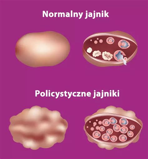 Zesp Policystycznych Jajnik W Oficjalna Witryna Mioxselle