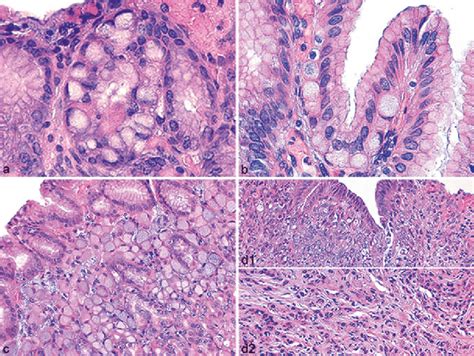 1 Morphological Spectrum Of Precursor Intramucosal And Widely