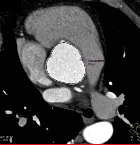 Central Line Mapping Of A Dilated Ascending Aorta Cardiac Case