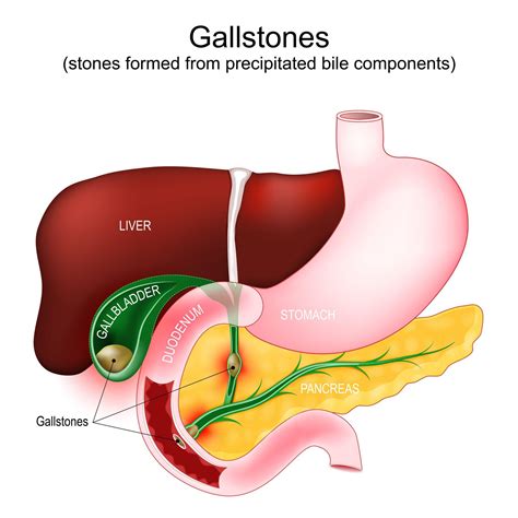 What is Gallbladder Surgery? - GBL Hospital