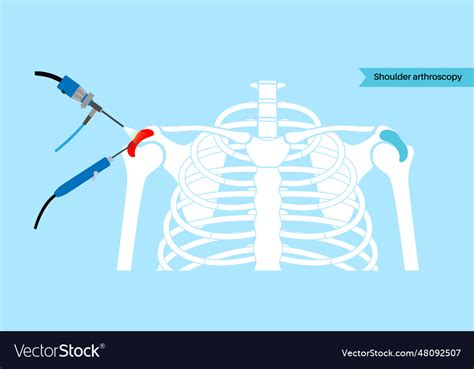 Shoulder Arthroscopy Poster Royalty Free Vector Image